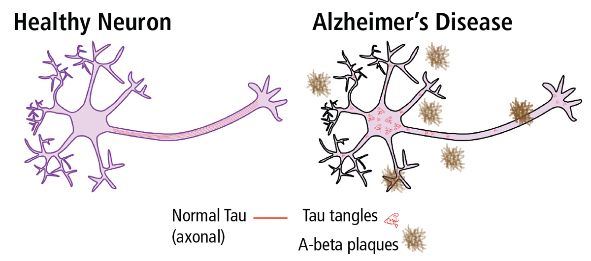 Insights into Alzheimer’s Disease – The Official Blog of Edvotek®